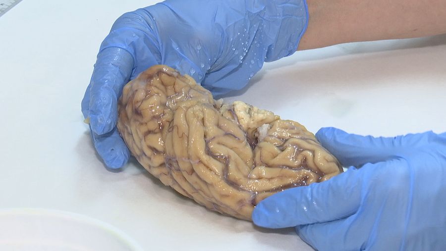 Cerebro donado al Biobanco de Ciudad Real