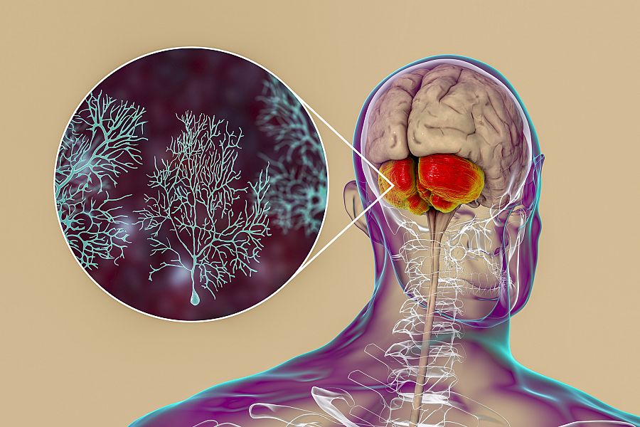 Cerebro humano con cerebelo resaltado y vista de cerca de las neuronas Purkinje