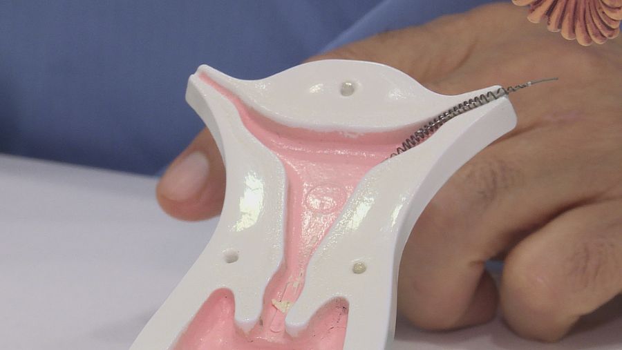 El Essure es un muelle de níquel de 4 cm de largo por 0,8 de grosor que se implantaba en las trompas de falopio