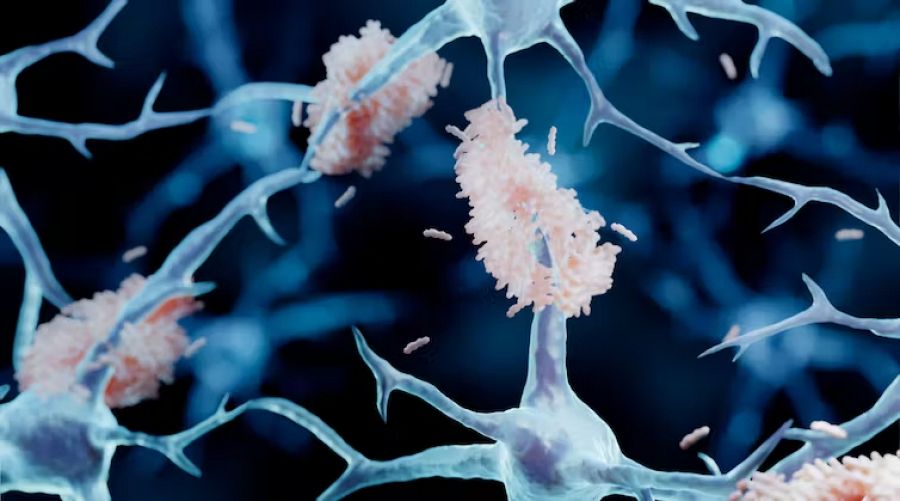 Placas de beta-amiloide (rosa) aglomerándose en las neuronas (células cerebrales).