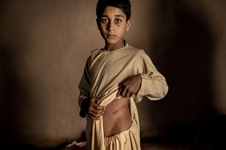 Imagen del niño afgano Khalil Ahmad, cuyos padres vendieron su riñón por 3.500 dólares.