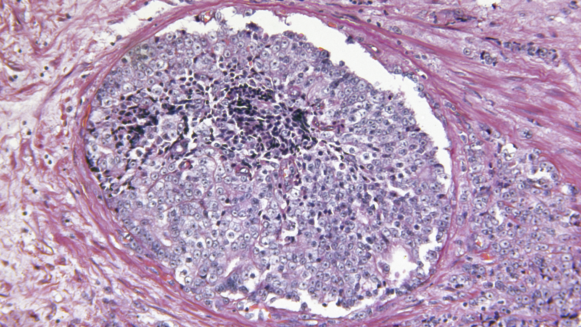 consorcio de investigación del cáncer de próstata