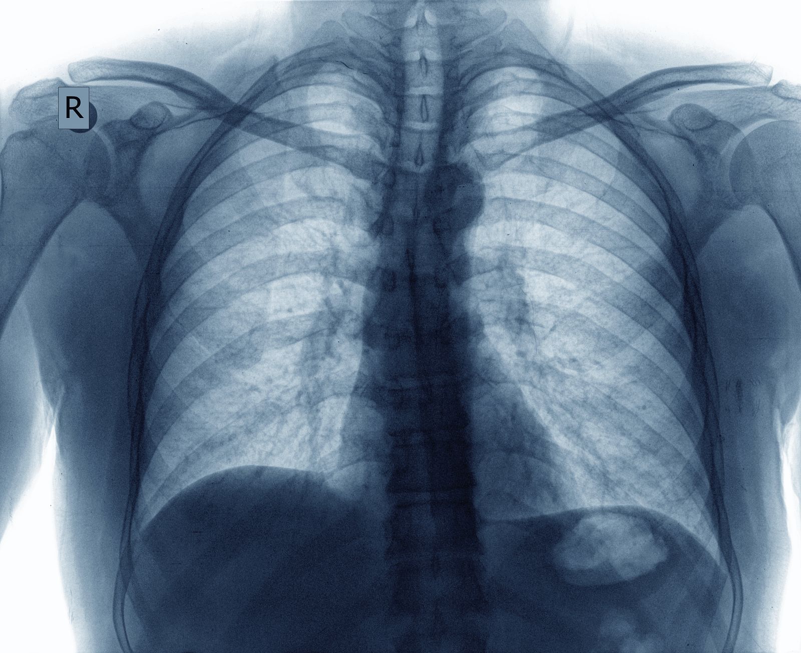 Radiografía de unos pulmones.
