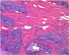 Hacen una nueva clasificación del cáncer de mama basada en factores no genéticos