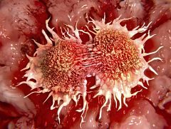 Un mecanismo de comunicación física entre células promueve la metástasis en cáncer