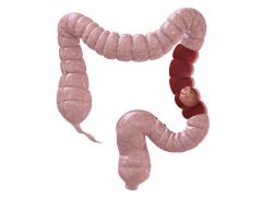 Una combinación de dos fármacos logra reducir el cáncer de colon en el 67% de los casos