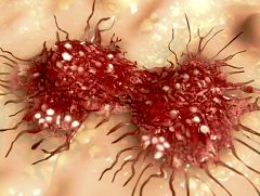 Identifican el mecanismo que hace que el cáncer cree metástasis