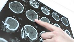 El ictus afecta a 120.000 personas cada año en España y es la primera causa de incapacidad