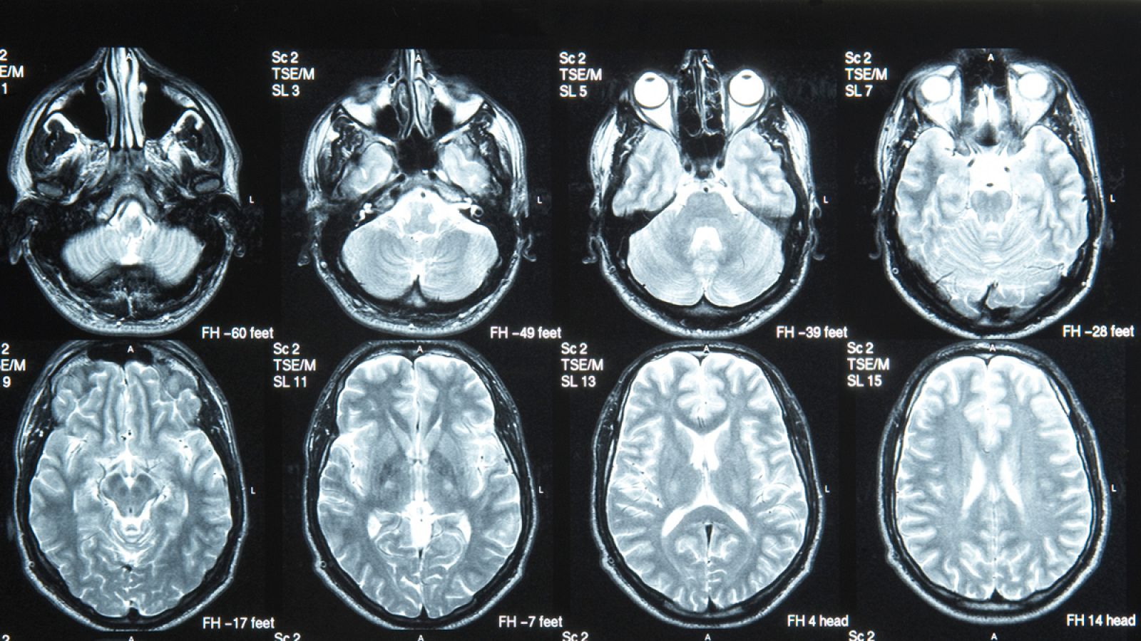 Las únicas terapias actuales contra el ictus sólo son útiles para un 10 % de los casos.