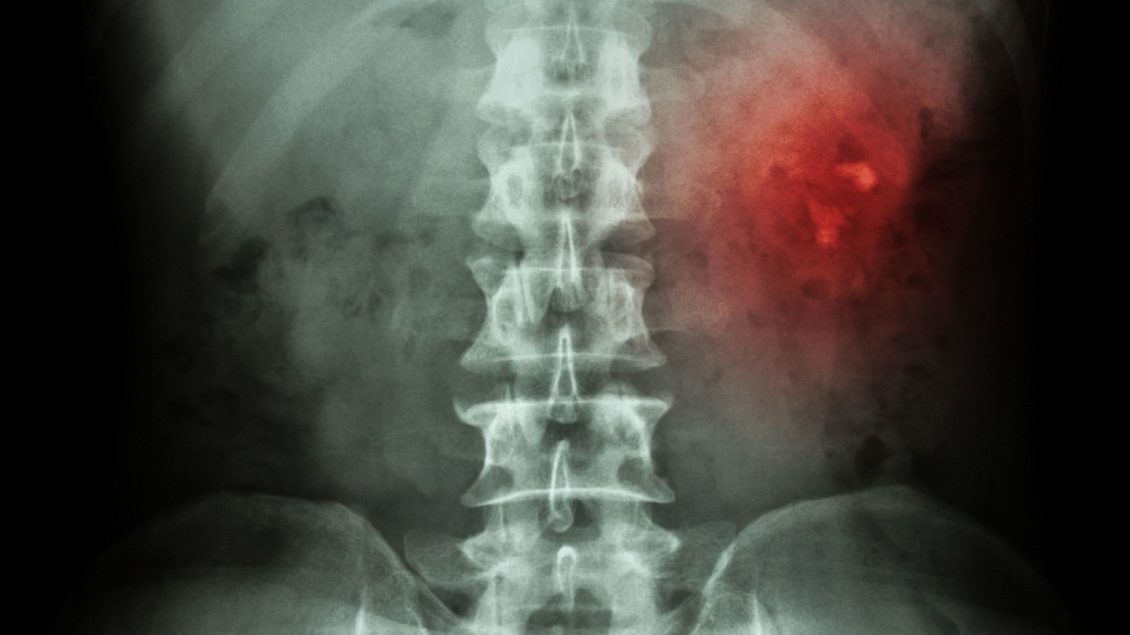 En España, se dan anualmente entre 300 y 400 mil casos de primeras crisis de cólico nefrítico.