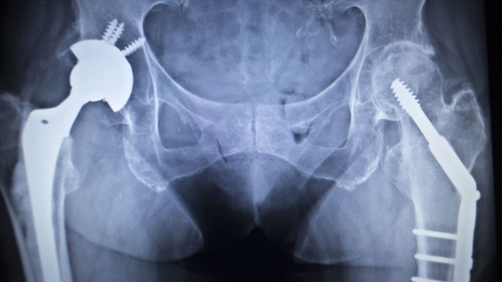 Con esta nueva tecnología pueden ser tratadas distintas aleaciones de uso médico.