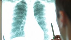 España contará con un registro de cáncer de pulmón