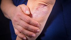 Identificada una molécula clave en el desarrollo de la psoriasis