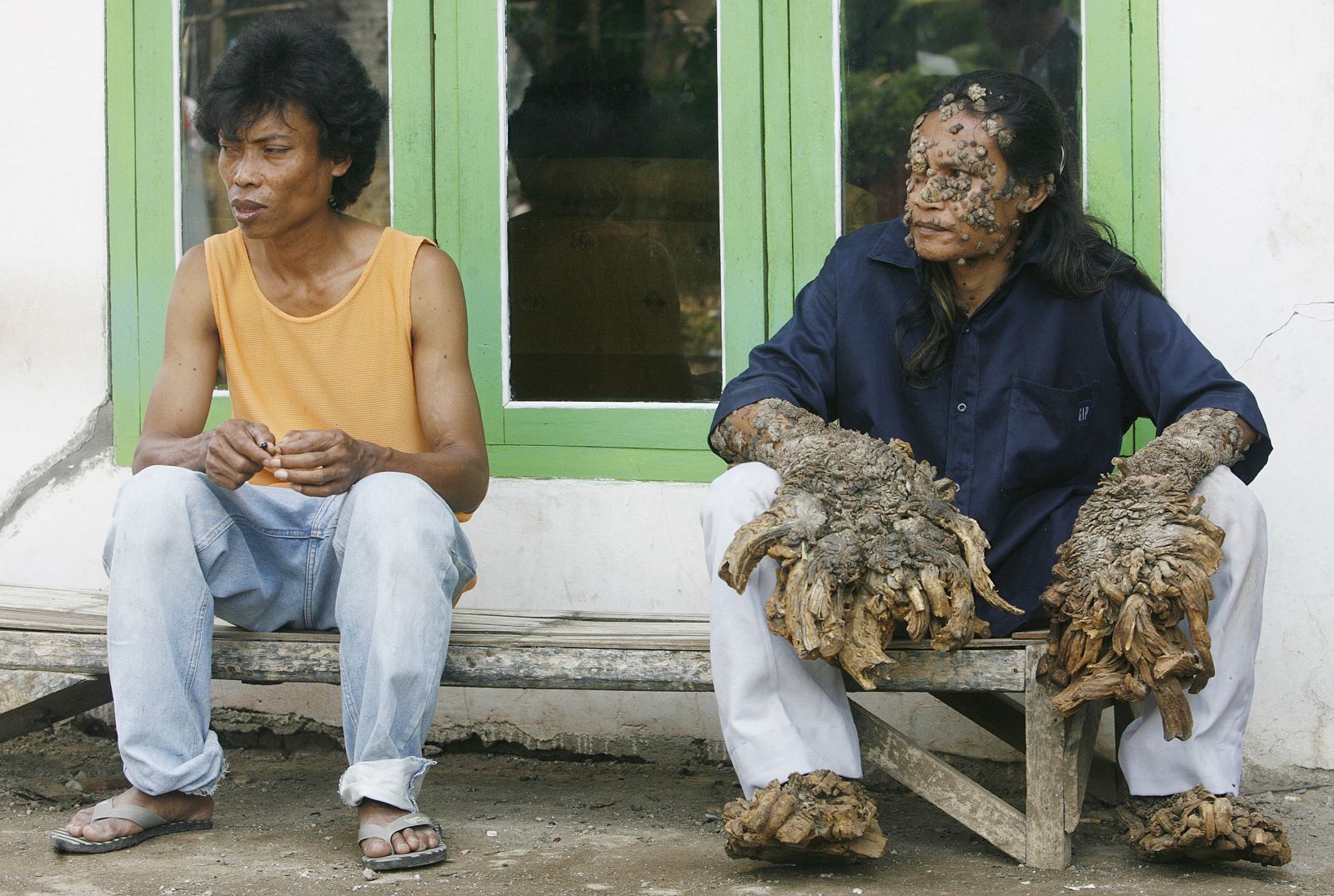 El "hombre árbol" pierde sus "raíces"