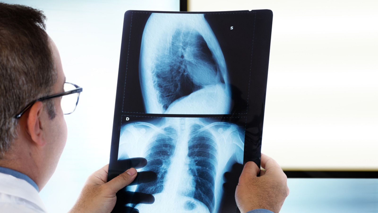 La neumonía es una enfermedad pulmonar grave de origen infeccioso.