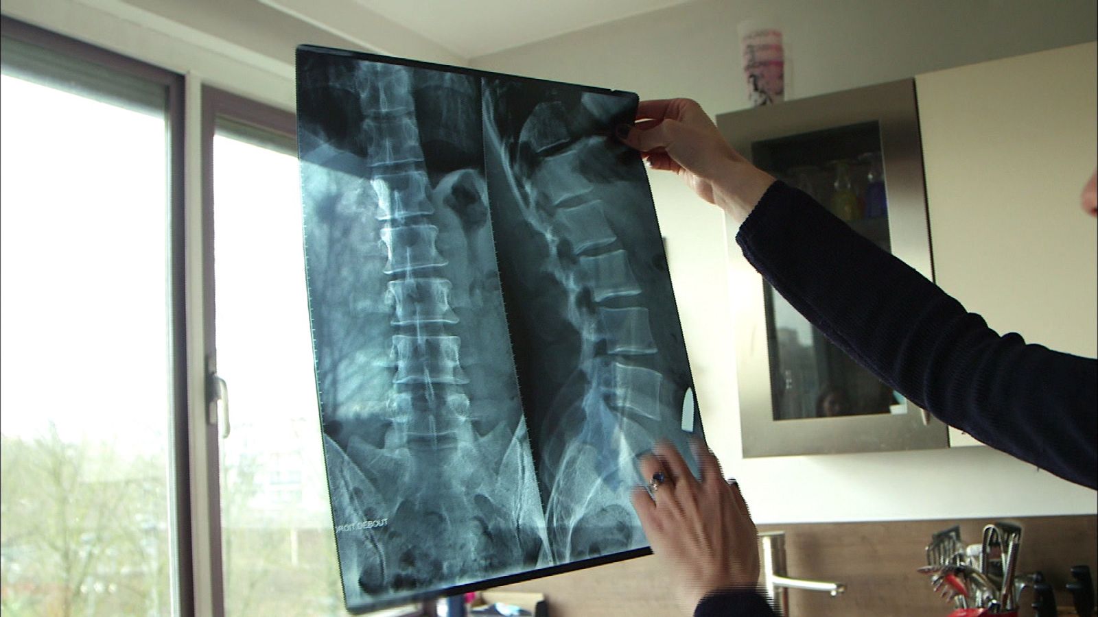 Radiografia que muestra la bala incrustada en el cuerpo de Jean Camille