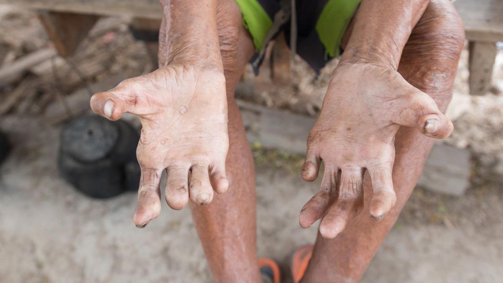 Manos de un hombre enfermo de lepra, como se conoce a la enfermedad de Hansen