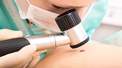 Desarrollan una nueva técnica de diagnóstico para la detección precoz del melanoma