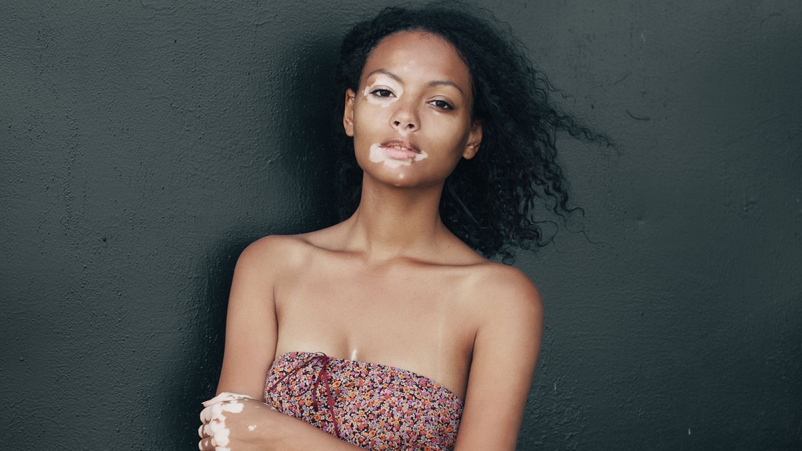 El vitíligo se produce cuando el sistema inmune borra por error los melanocitos normales de la piel, provocando que aparezcan zonas despigmentadas.