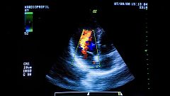 Investigadores españoles descubren una enzima que favorece la hipertrofia cardiaca