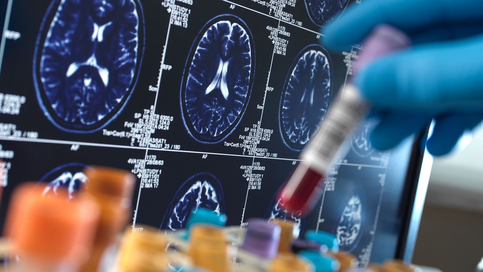 El gen APOE codifica la apolipoproteína E.