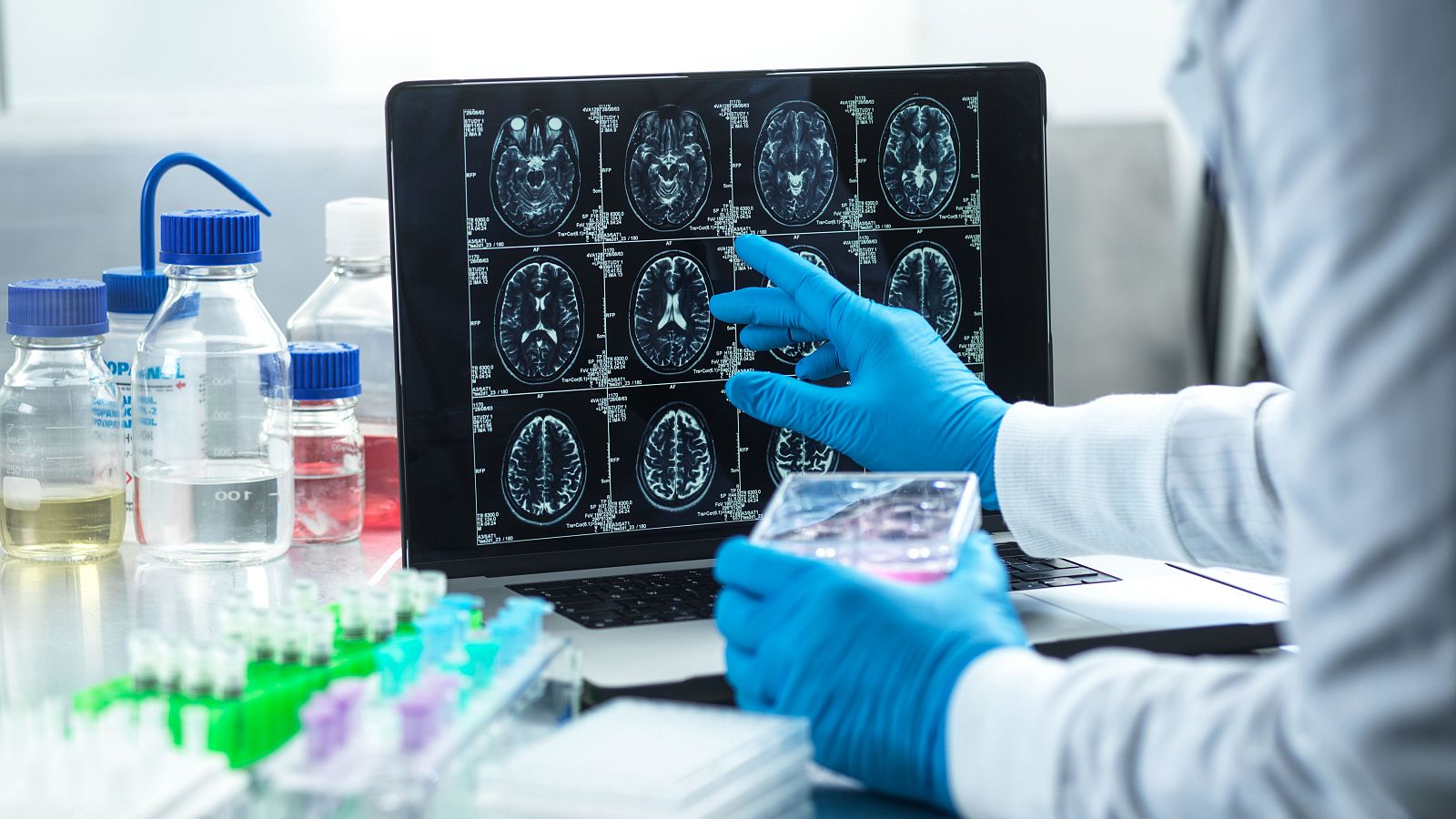 En España, más de 300.000 personas están afectadas de párkinson.