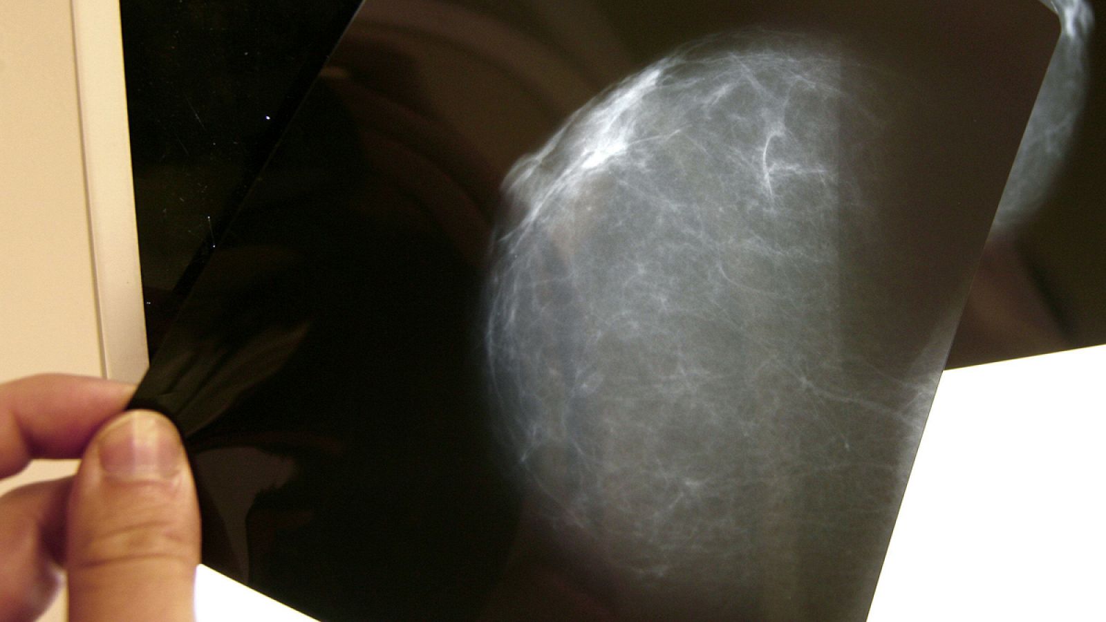 Fotografía de una prueba radiológica de mama.