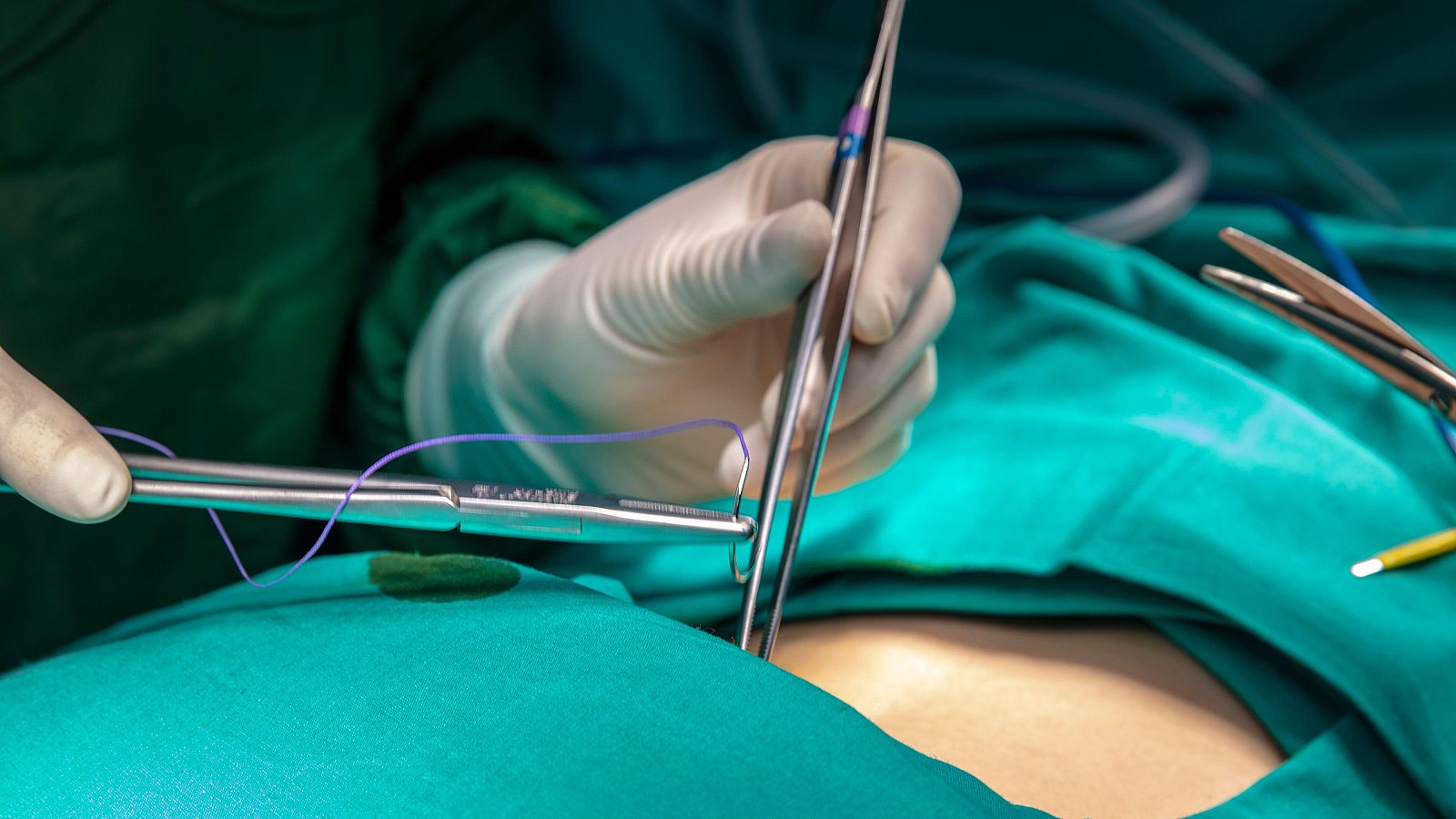 Un hígado de cerdo modificado genéticamente podría funcionar trasplantado en una persona