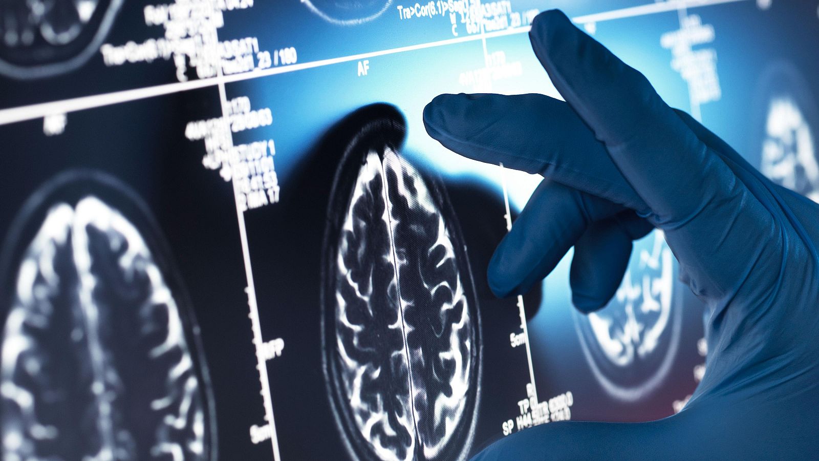 Investigadores descubren un mecanismo para revertir la pérdida de memoria