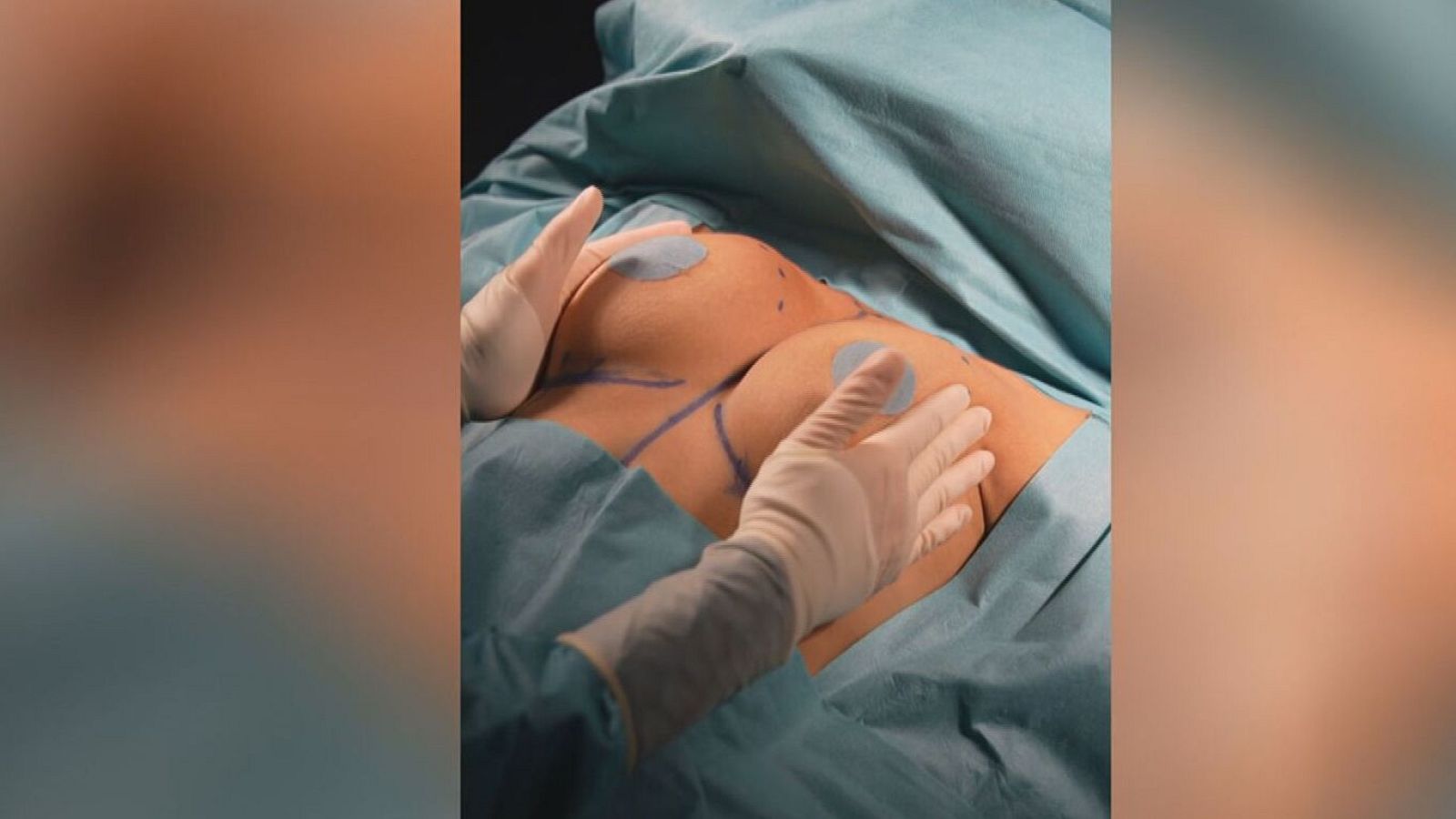 Cirugía estética de mama: torso de paciente en quirófano con marcas preoperatorias y apósitos.  Manos enguantadas palpando el pecho.