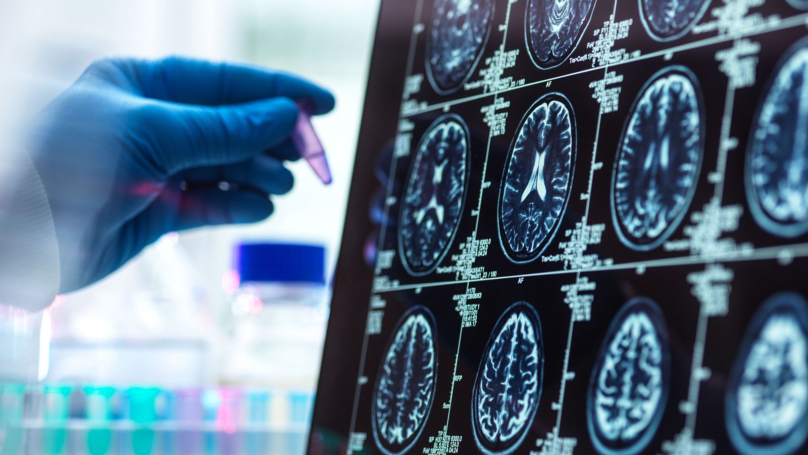 El párkinson es la segunda enfermedad neurodegenerativa con mayor prevalencia en el mundo.