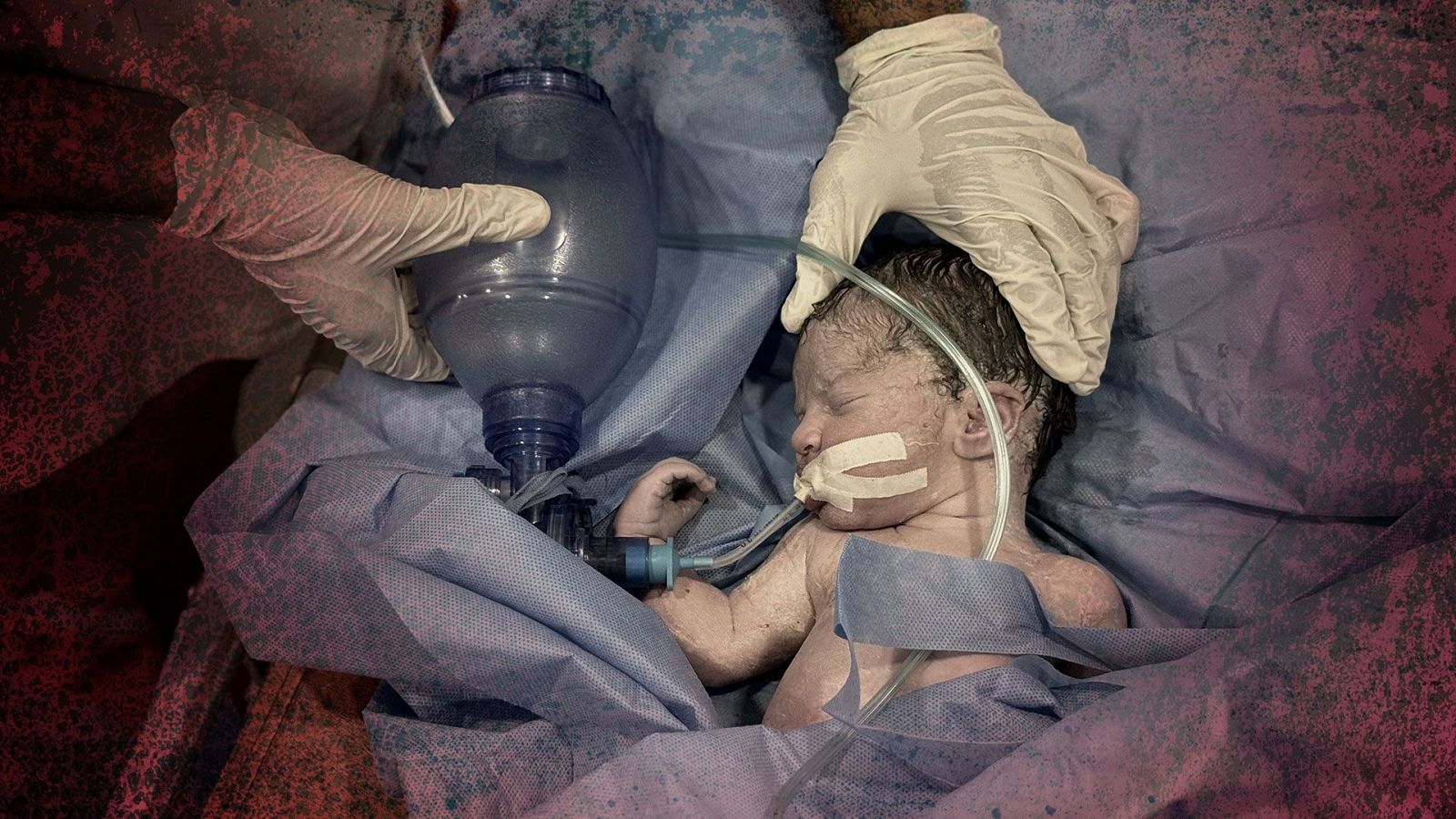 Médicos atienden a un recién nacido en Jan Yunis, Gaza, después de que su madre, embarazada de siete meses, muriera en un ataque israelí el 28 de julio de 2025.