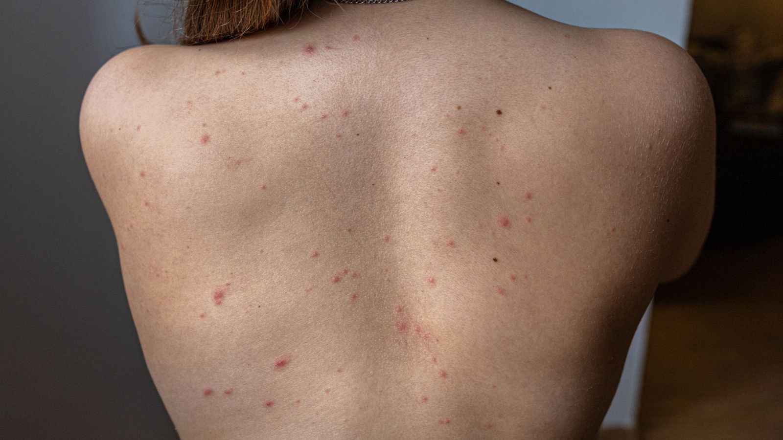 Los contagios de sarna aumentan de forma "muy significativa" en España