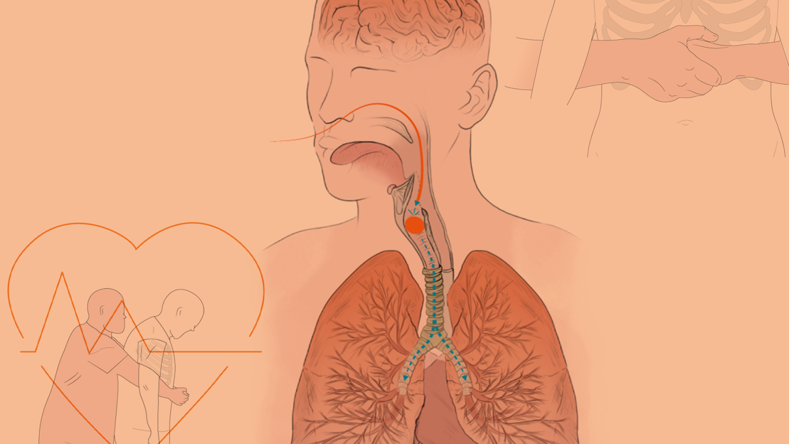 Atragantamientos en Navidad: cómo ocurren y cómo evitarlos