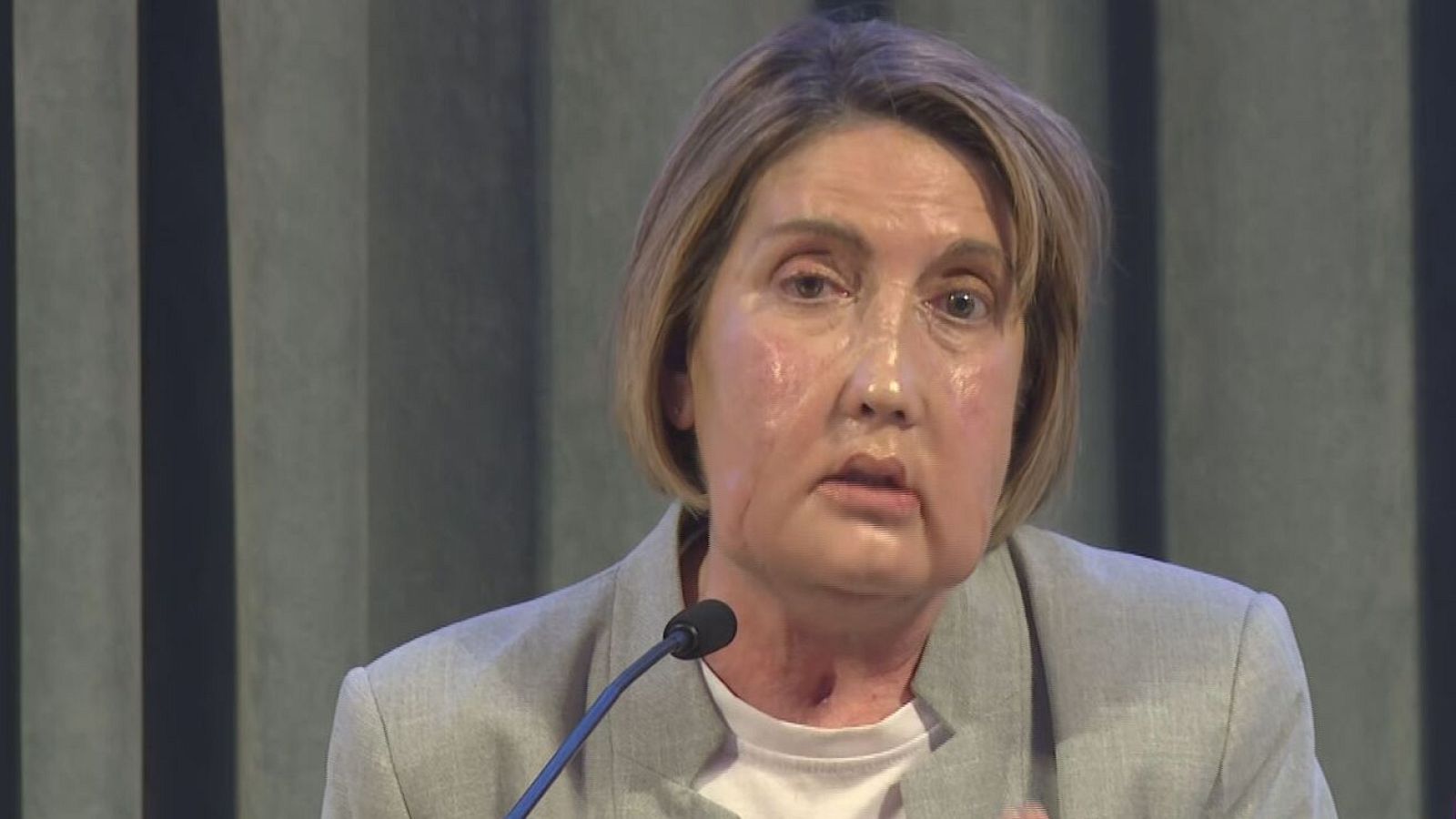 La Carme, pacient receptora del trasplantament de cara en roda de premsa explicant el seu cas