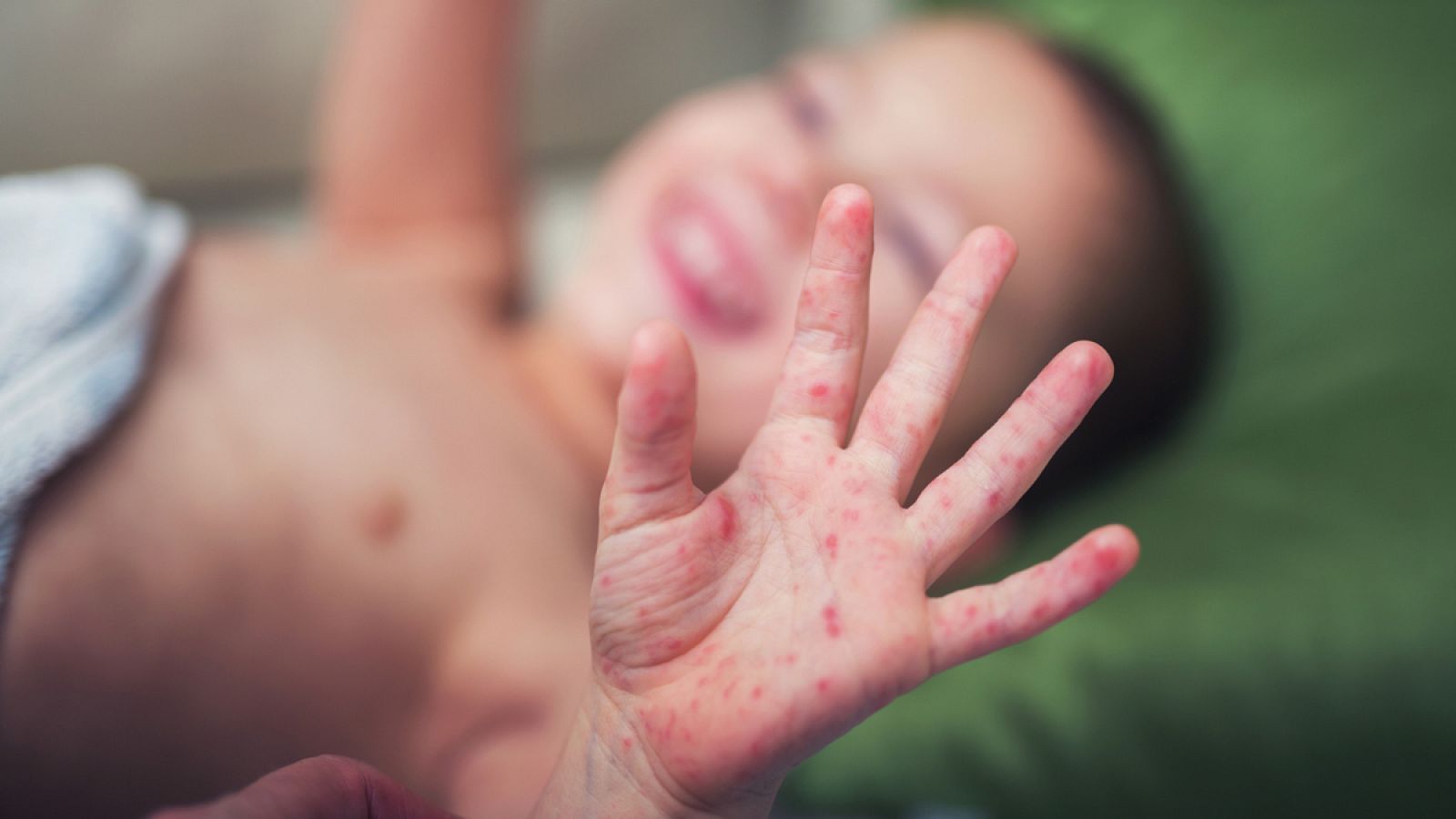 La erupción cutánea del sarampión acaba por afectar manos y pies.