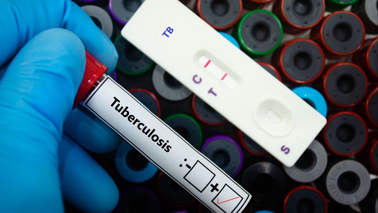 Resultado positivo de tuberculosis en tubo de ensayo; prueba rápida de TB y otros tubos visibles en el fondo.  Entorno clínico o de laboratorio.