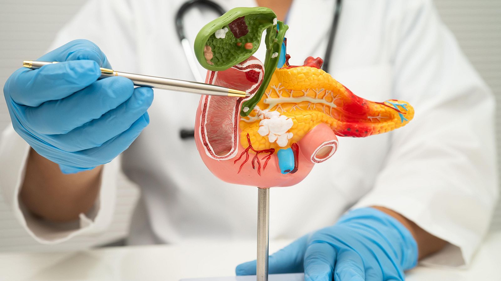 Una vacuna personalizada de ARN mensajero muestra supervivencias prolongadas en cáncer de páncreas.