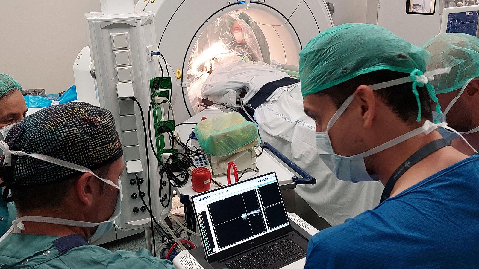 Operació de neurocirurgia per implantar ECP a un pacient per millorar la síndrome de Tourette