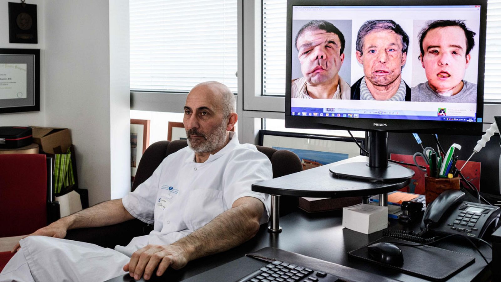 Laurent Lantieri, jefe del equipo médico que ha realizado el segundo transplante de cara a Jerôme Hamon, posa junto a una fotografía de las tres caras que ha tenido su paciente