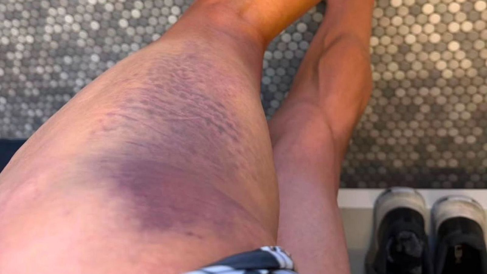 Primer plano de un muslo con un gran hematoma morado y azulado, con bordes rojizos y amarillentos. Se ven zapatillas oscuras y un fondo de mosaico gris y blanco.