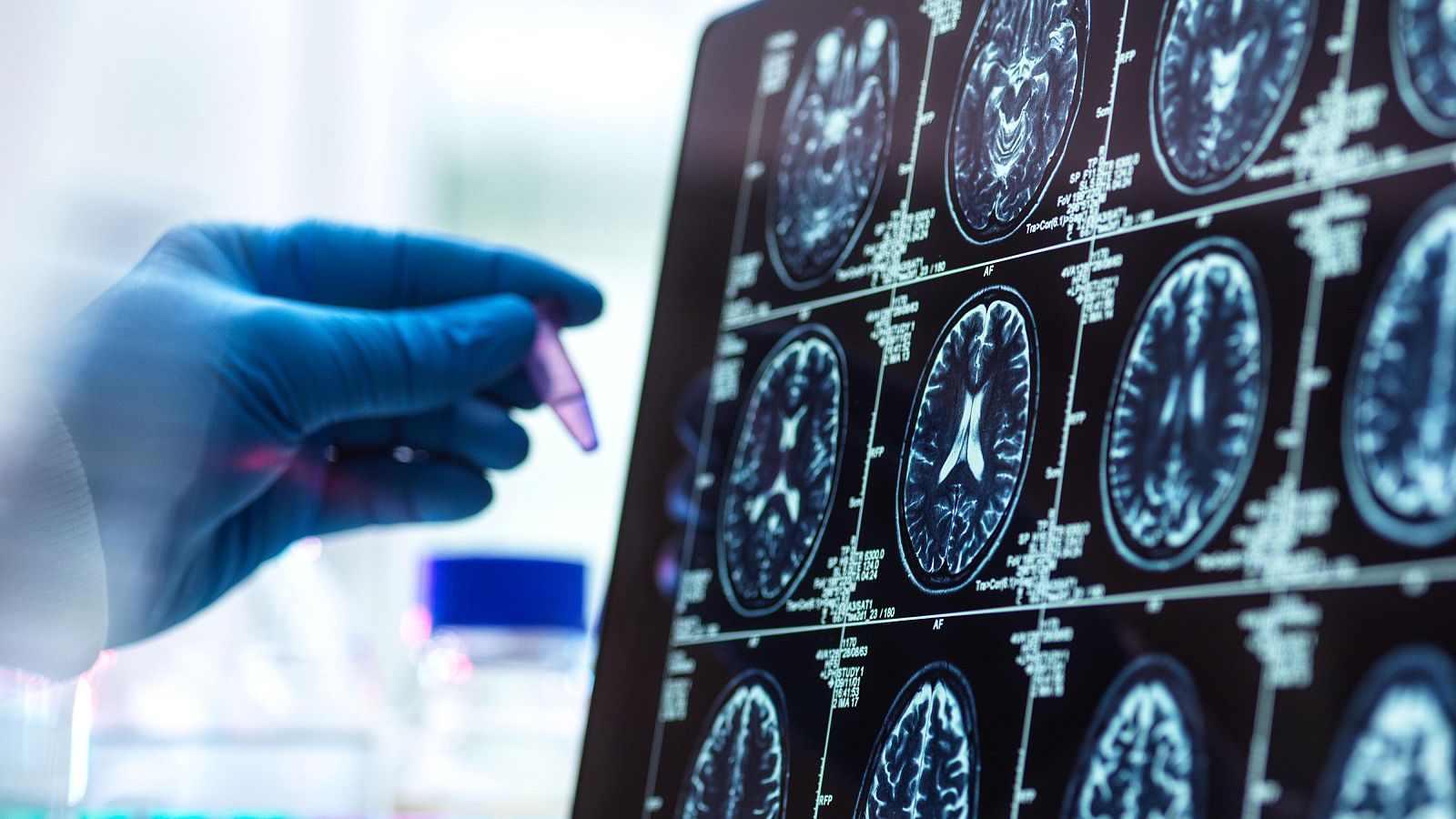 Científicos españoles descubren una vía para combatir la metástasis cerebral