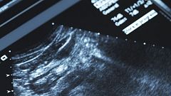 Un estudio halla un vínculo entre la placenta y el desarrollo de la esquizofrenia