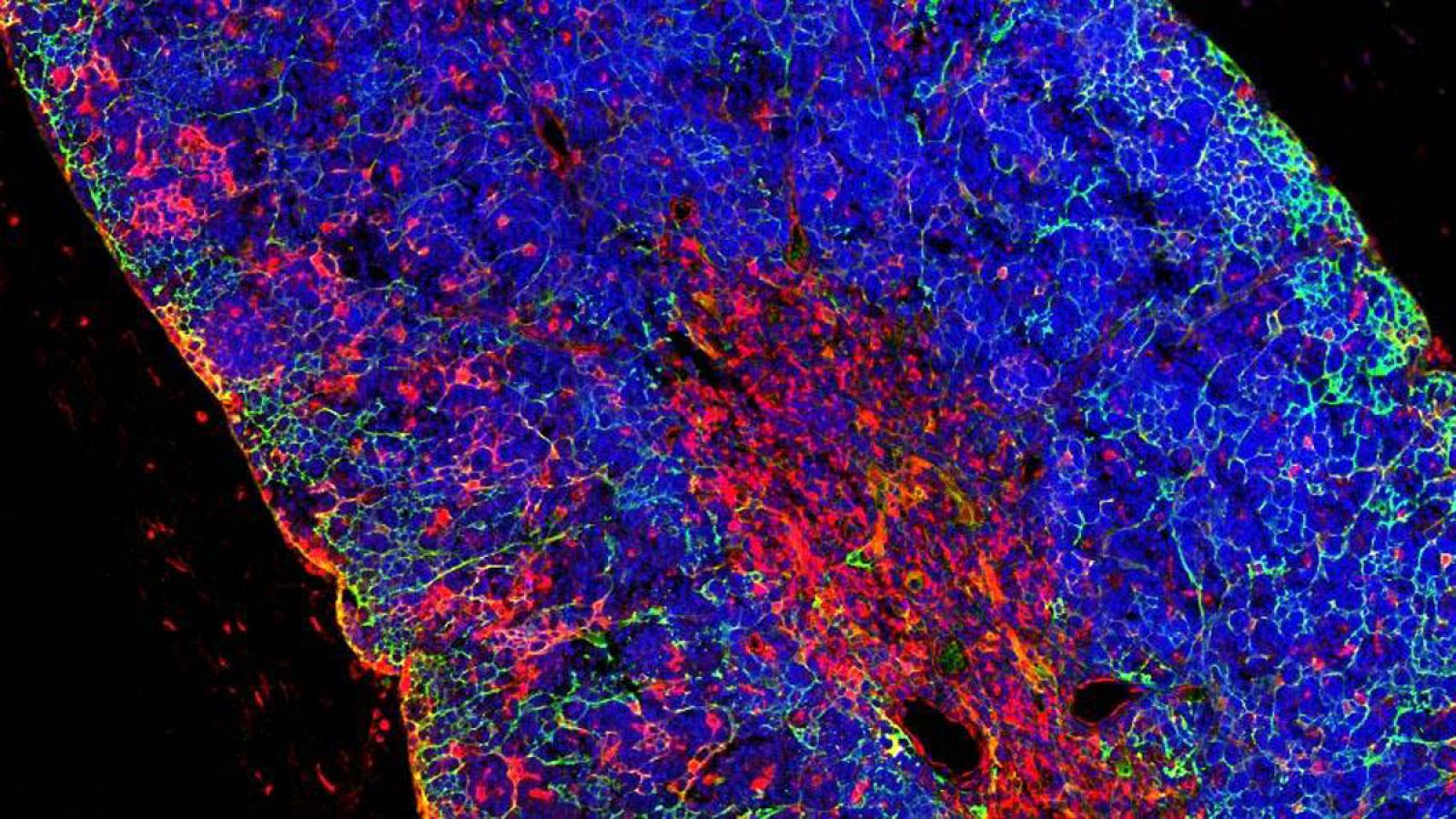 La leucemia linfoblástica aguda de células T es un tumor agresivo producido por el crecimiento descontrolado de las células que producen linfocitos T (un tipo de glóbulos blancos).