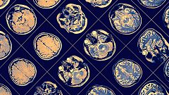 Descubren el umbral más bajo de la proteína cerebral asociada al alzhéimer