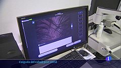 Un 25% dels pacients de covid-19 patirà una caiguda sobtada i abundant del cabell
