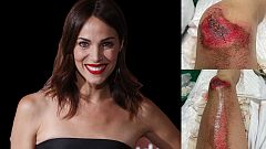 Así se ha quedado Nerea Garmendia después del accidente de moto