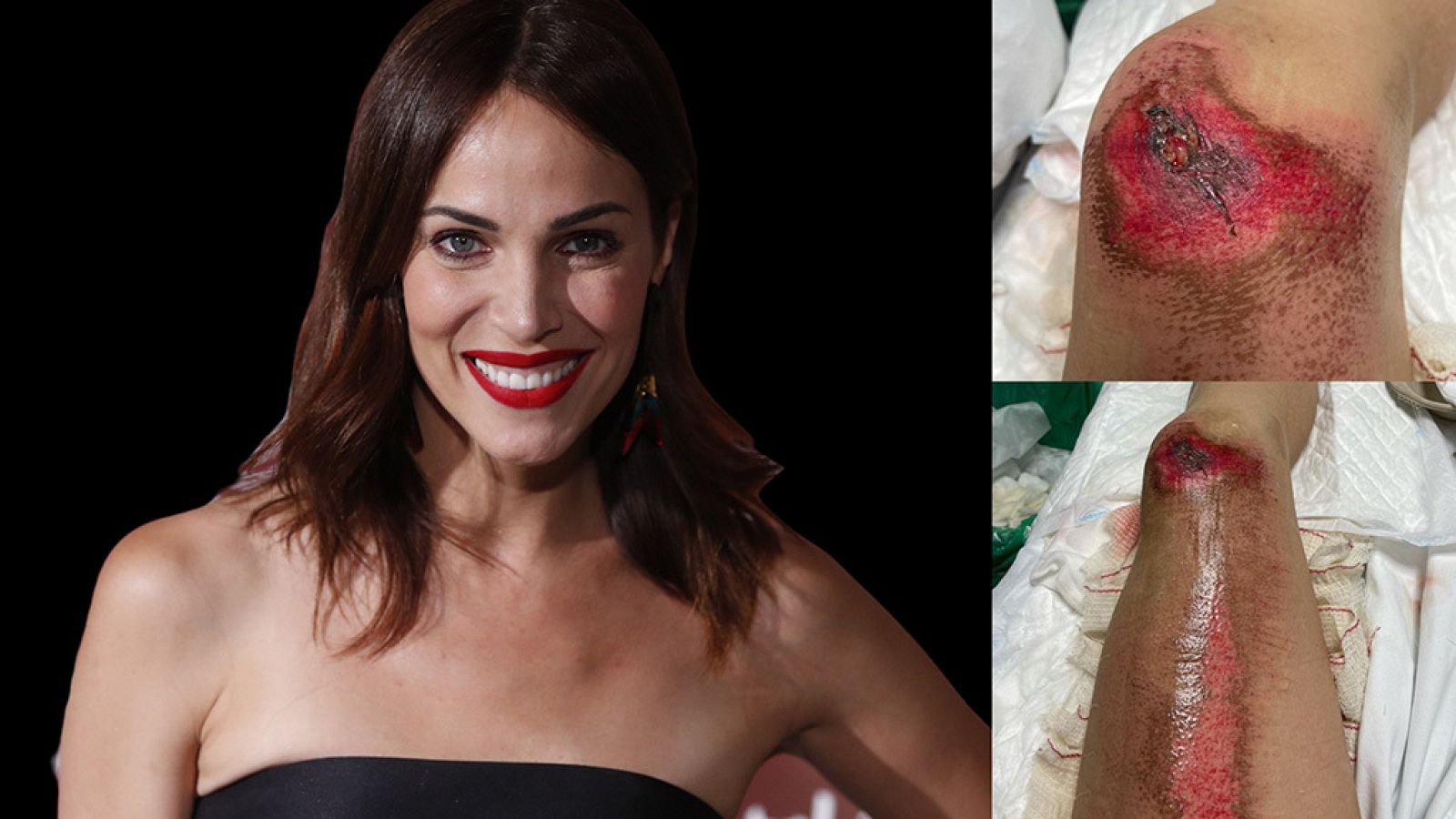 Nerea Garmendia enseña las heridas de su accidente de moto