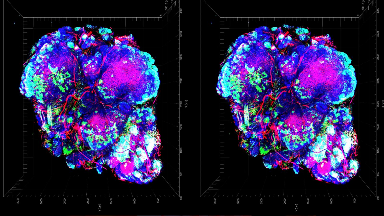 Tumor con zonas de hipoxia en color verde