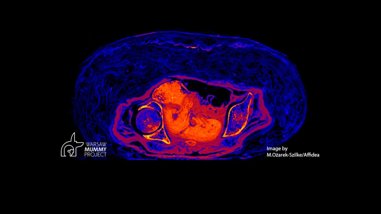 Imagen del feto de Warsaw Mummy Project